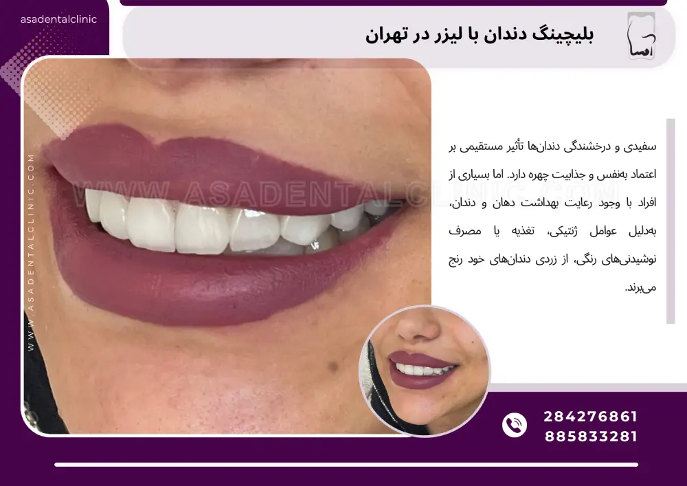Laser teeth bleaching in Tehran بلیچینگ دندان با لیزر در تهران