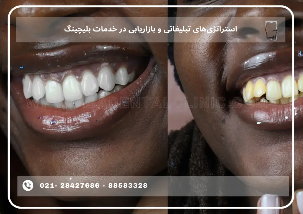 Teeth bleaching pricing (1) استراتژیهای تبلیغاتی و بازاریابی در خدمات بلیچینگ