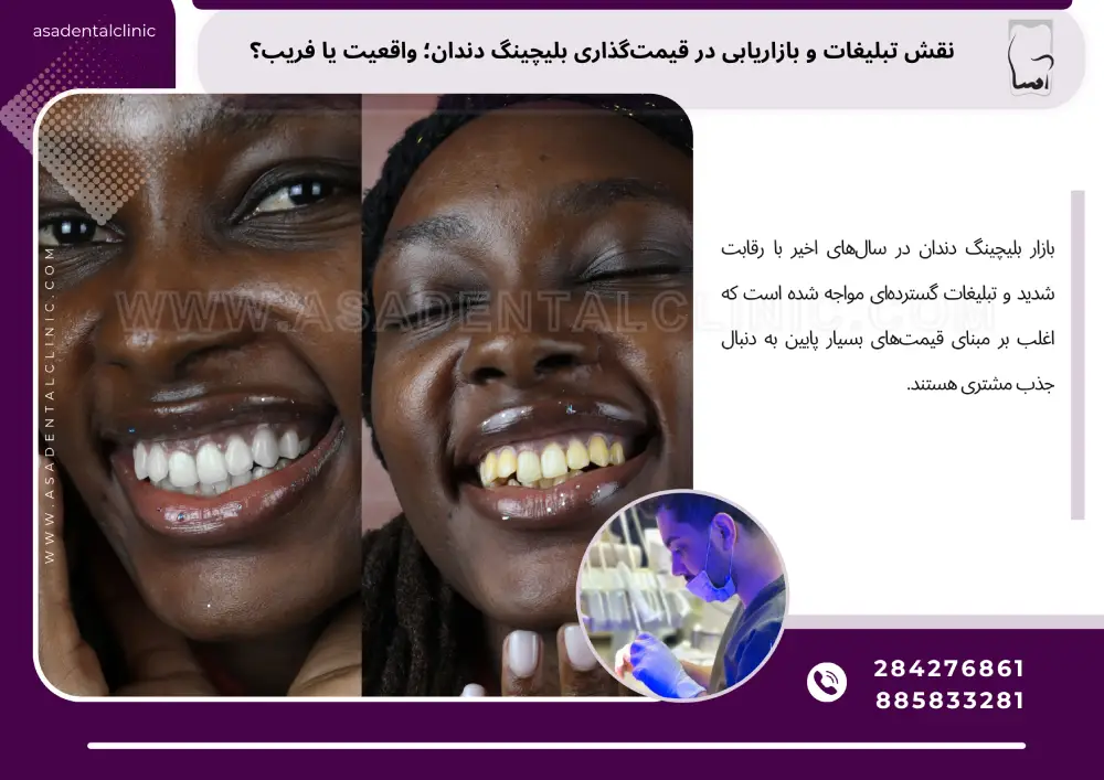 Teeth bleaching pricing نقش تبلیغات و بازاریابی در قیمتگذاری بلیچینگ دندان؛ واقعیت یا فریب؟