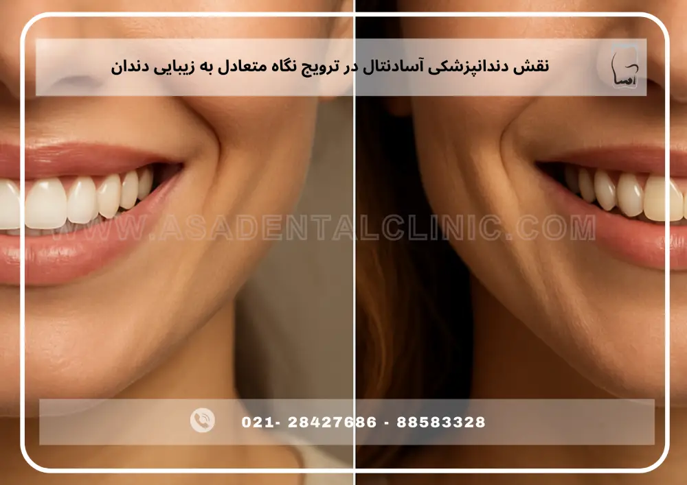 teeth whitening (1) سفید کردن دندان