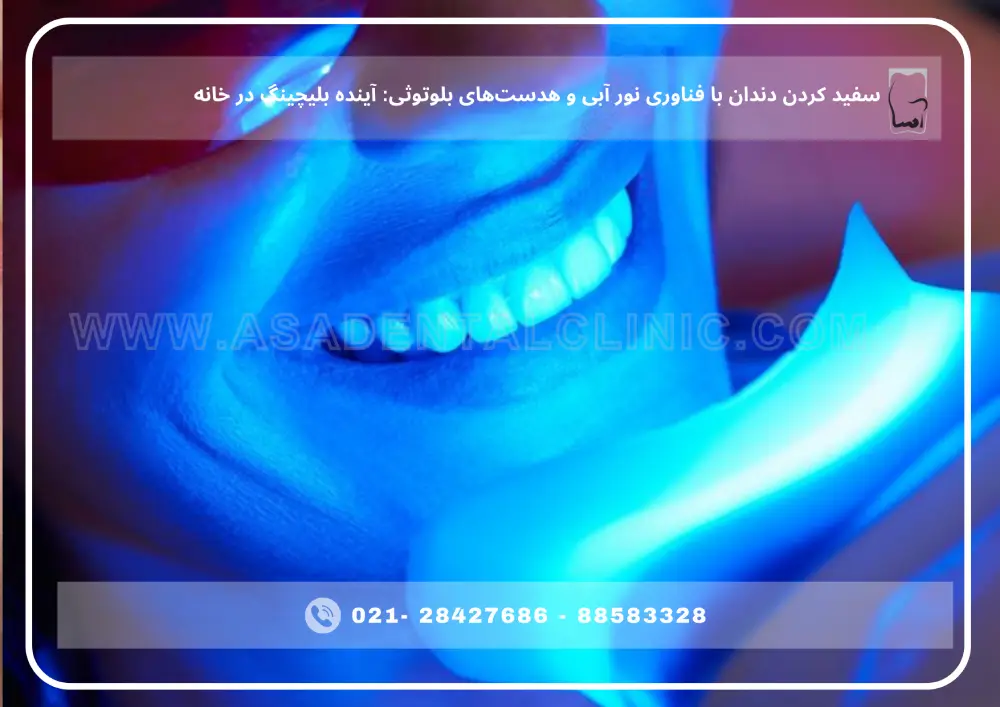 teeth whitening (1) سفید کردن دندان در خانه