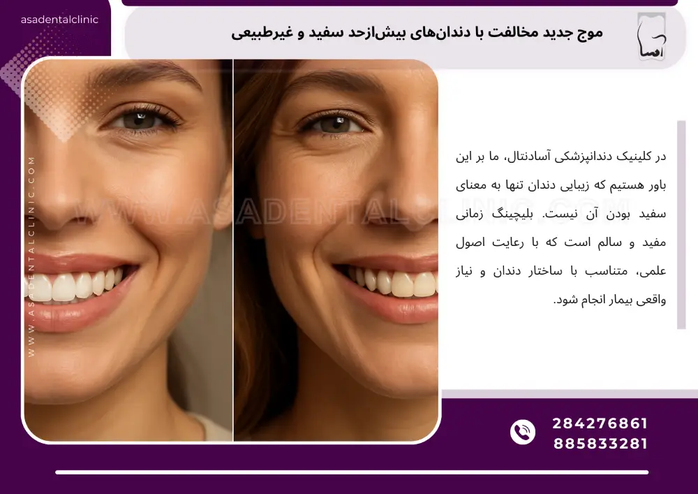 سفید کردن دندان