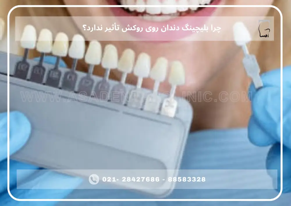 Dental veneers (1) چرا بلیچینگ دندان روی روکش تأثیر ندارد؟