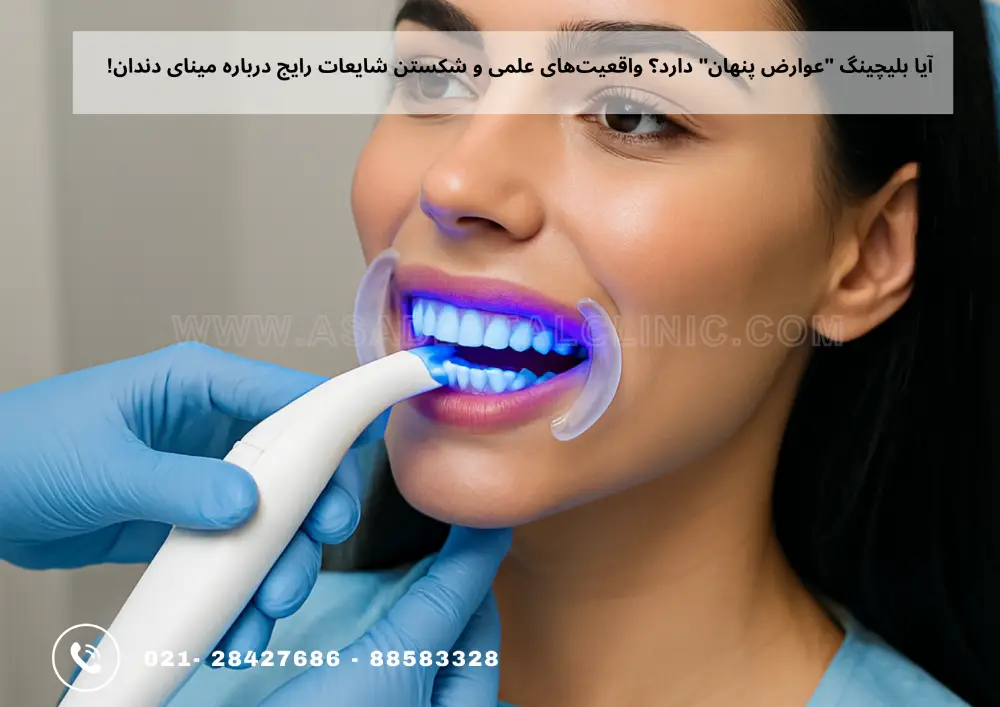 Teeth bleaching (1) بلیچینگ دندان
