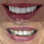 تصویر قبل و بعد بلیچینگ دندان