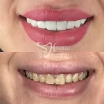 تصویر قبل و بعد بلیچینگ دندان