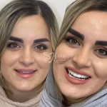 تصویر قبل و بعد بلیچینگ دندان