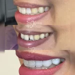 تصویر قبل و بعد بلیچینگ دندان