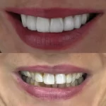 تصویر قبل و بعد بلیچینگ دندان