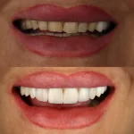 تصویر قبل و بعد بلیچینگ دندان