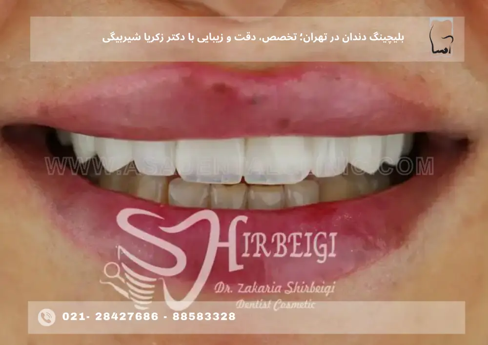 بلیچینگ دندان در تهران