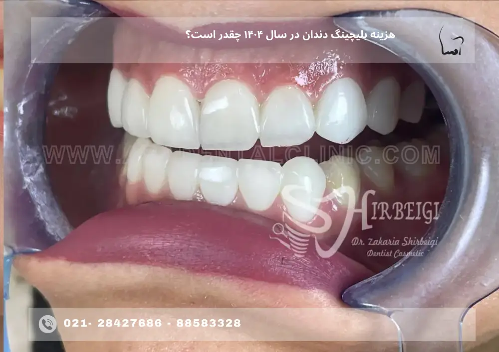 Teeth whitening cost (2) هزینه بلیچینگ دندان در سال ۱۴۰۴ چقدر است؟
