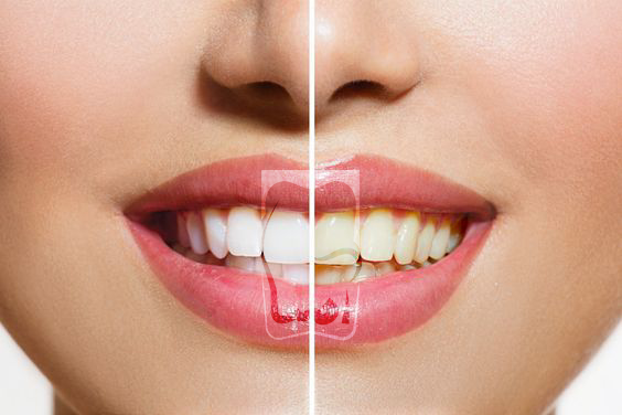 teeth whitening سفید کردن دندان