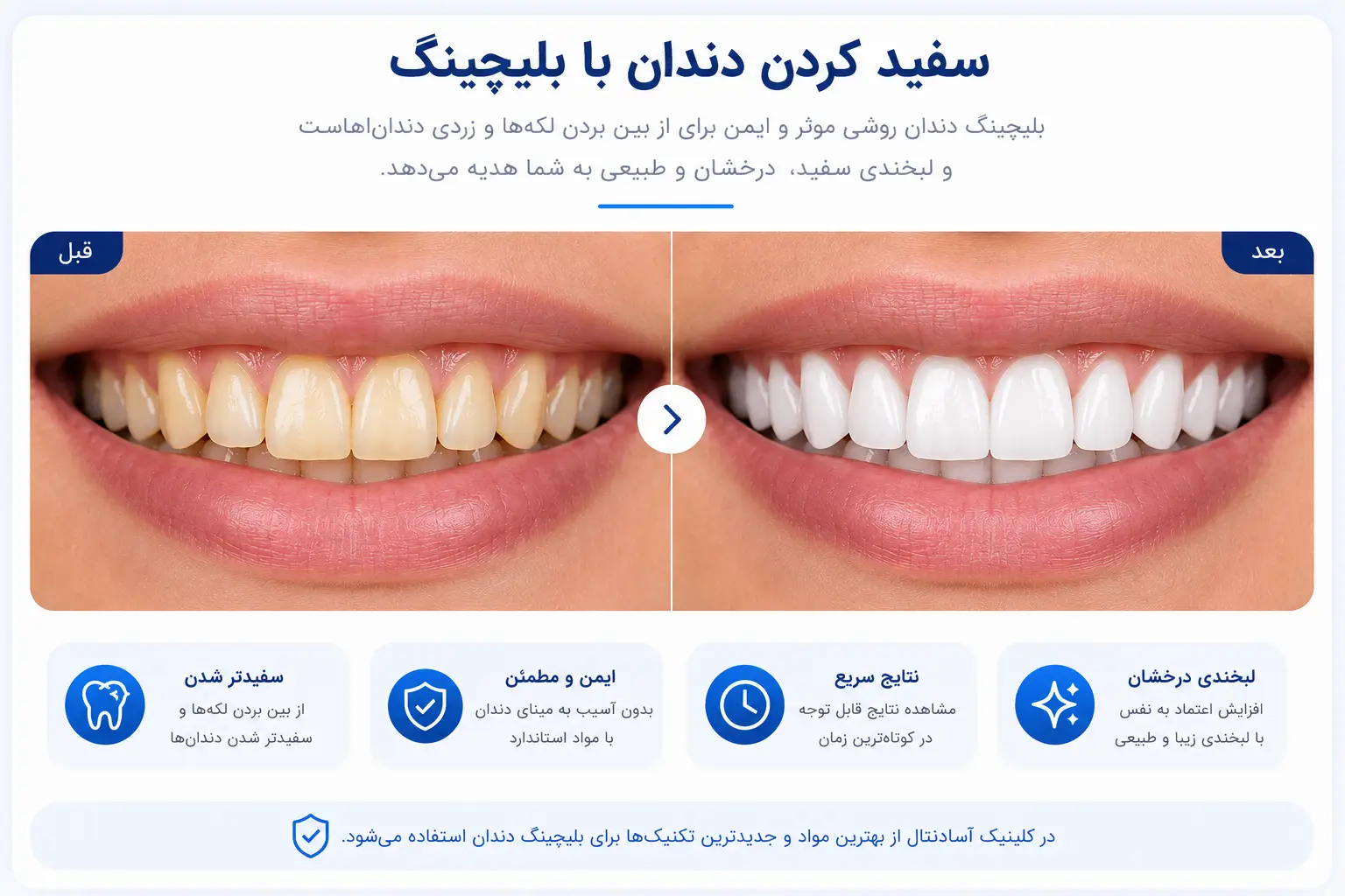 قبل و بعد سفید کردن دندان با بلیچینگ حرفه‌ای در کلینیک دندانپزشکی آسادنتال