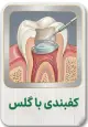 کفبندی با گلس